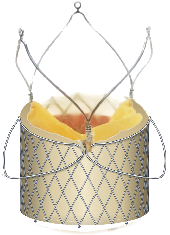 devie valve for aortic regurgitation: stent with grippers, bovine pericardium sutured inside (illustration)