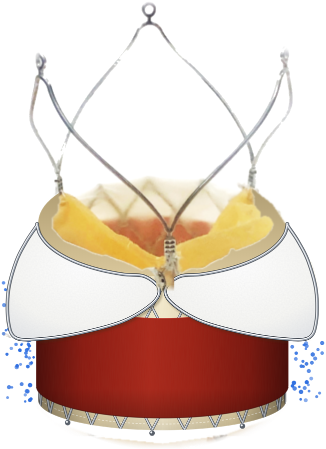 devie transcatheter valve with antibiotic-eluting skirt (illustration, investigational device)